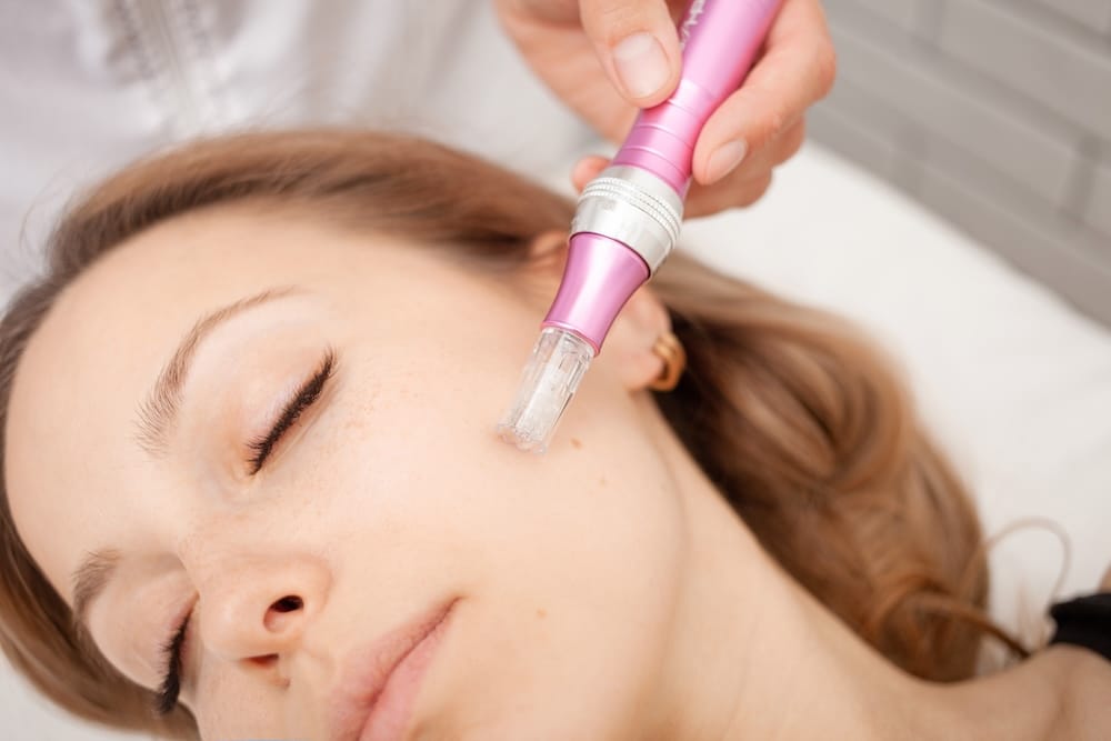 Imagen Microneedling