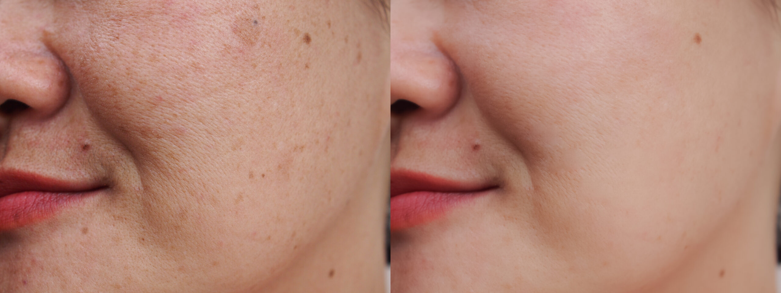 Imagen Tratamiento para mancha