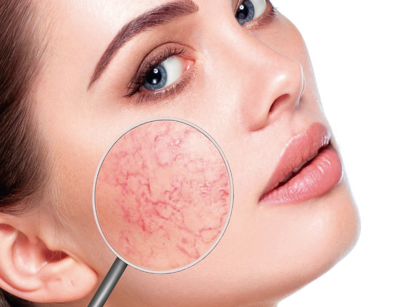 Imagen Tratamiento para piel sensible / con rosácea